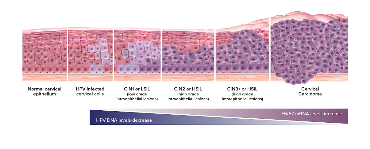 CCS Progression Illustration